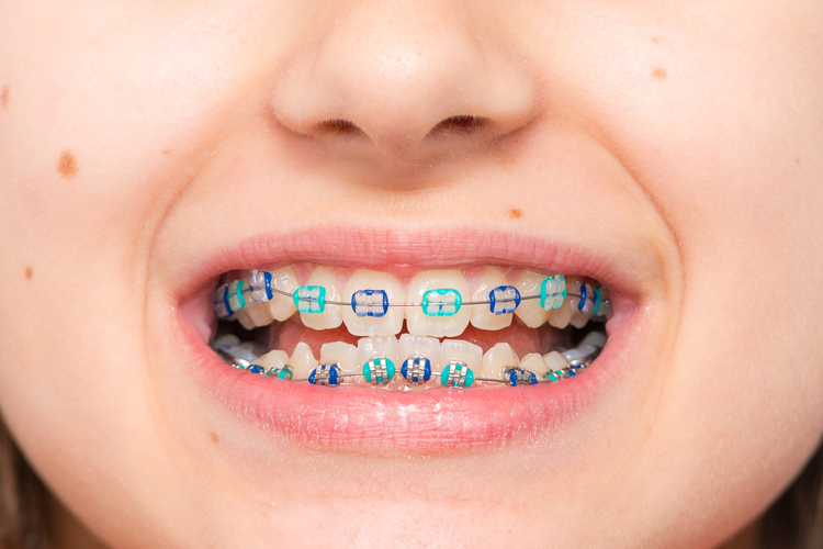 La ortodoncia infantil y la edad adecuada para iniciar un tratamiento