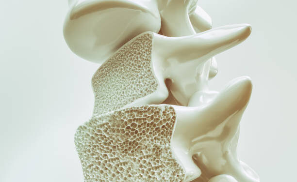 Alerta médica: usted podría padecer osteoporosis y desconocerlo