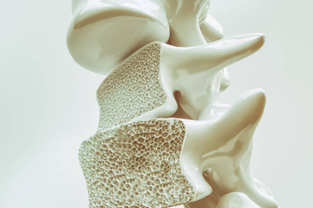 Alerta médica: usted podría padecer osteoporosis y desconocerlo