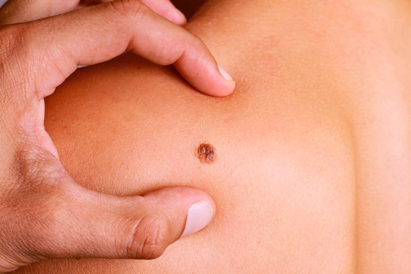 El melanoma: el cáncer de piel más agresivo que aumenta en Colombia, así puede prevenirlo