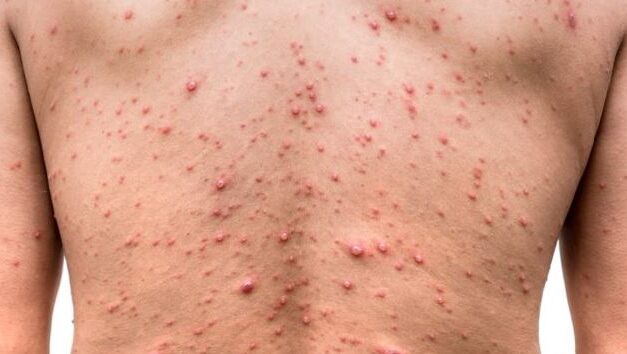 Atención: Ya son 22 los casos de viruela del mono confirmados en el Valle del Cauca