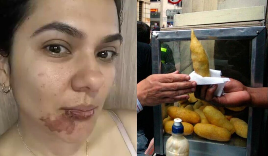 Mujer sufre quemaduras en su rostro por comerse una empanada en Medellín