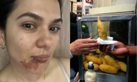 Mujer sufre quemaduras en su rostro por comerse una empanada en Medellín