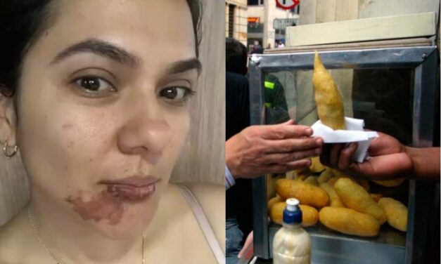 Mujer sufre quemaduras en su rostro por comerse una empanada en Medellín